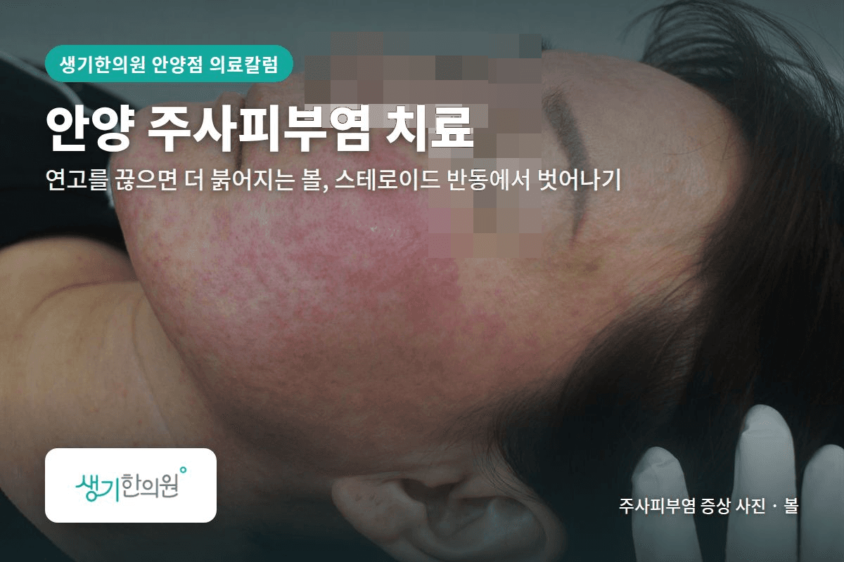 볼 주사피부염 증상 사진과 문구 「안양 주사피부염 치료, 연고를 끊으면 더 붉어지는 볼, 스테로이드 반동에서 벗어나기 · 생기한의원 안양점」