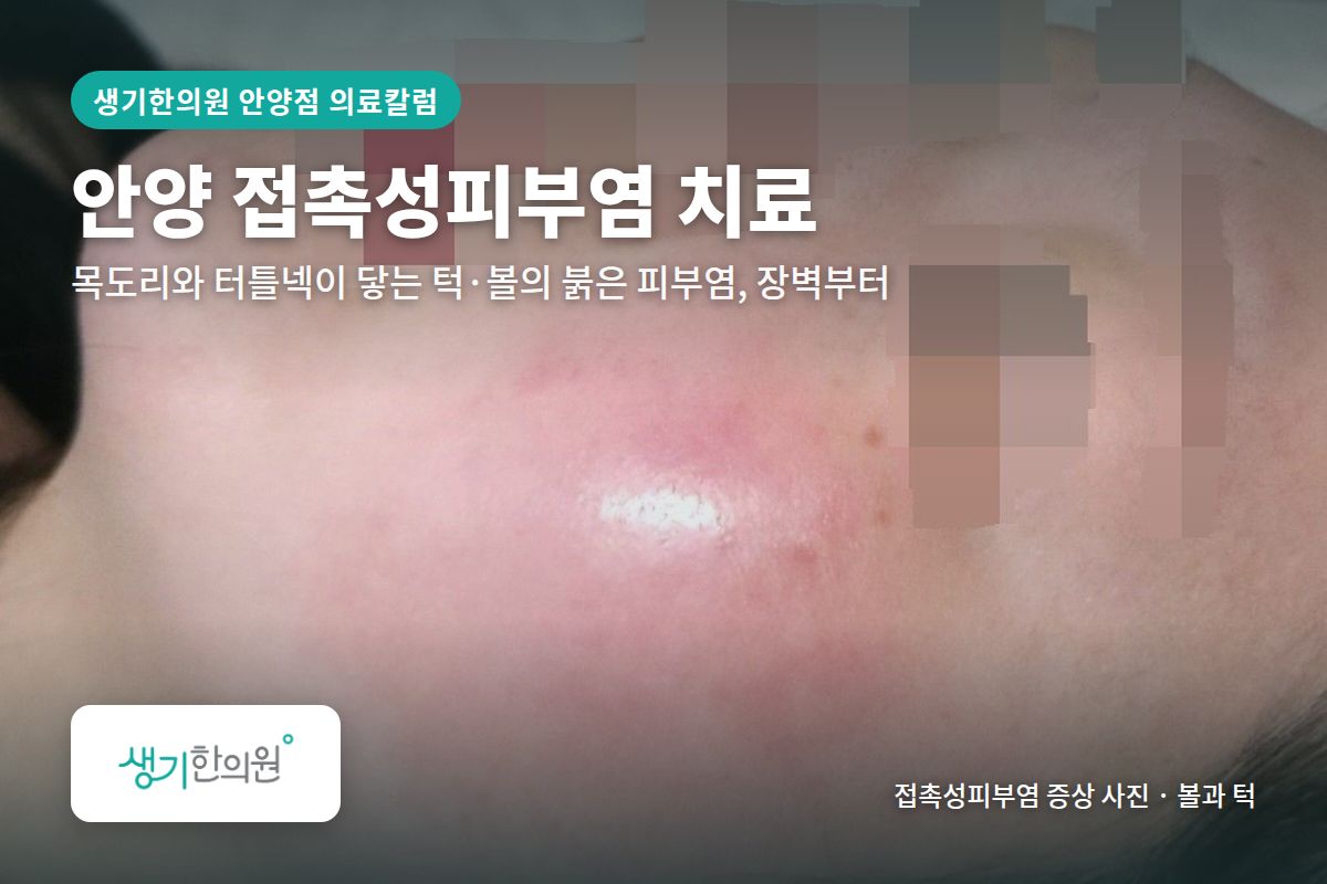 볼과 턱 접촉성피부염 증상 사진과 문구 「안양 접촉성피부염 치료, 목도리와 터틀넥이 닿는 턱·볼의 붉은 피부염, 장벽부터 · 생기한의원 안양점」