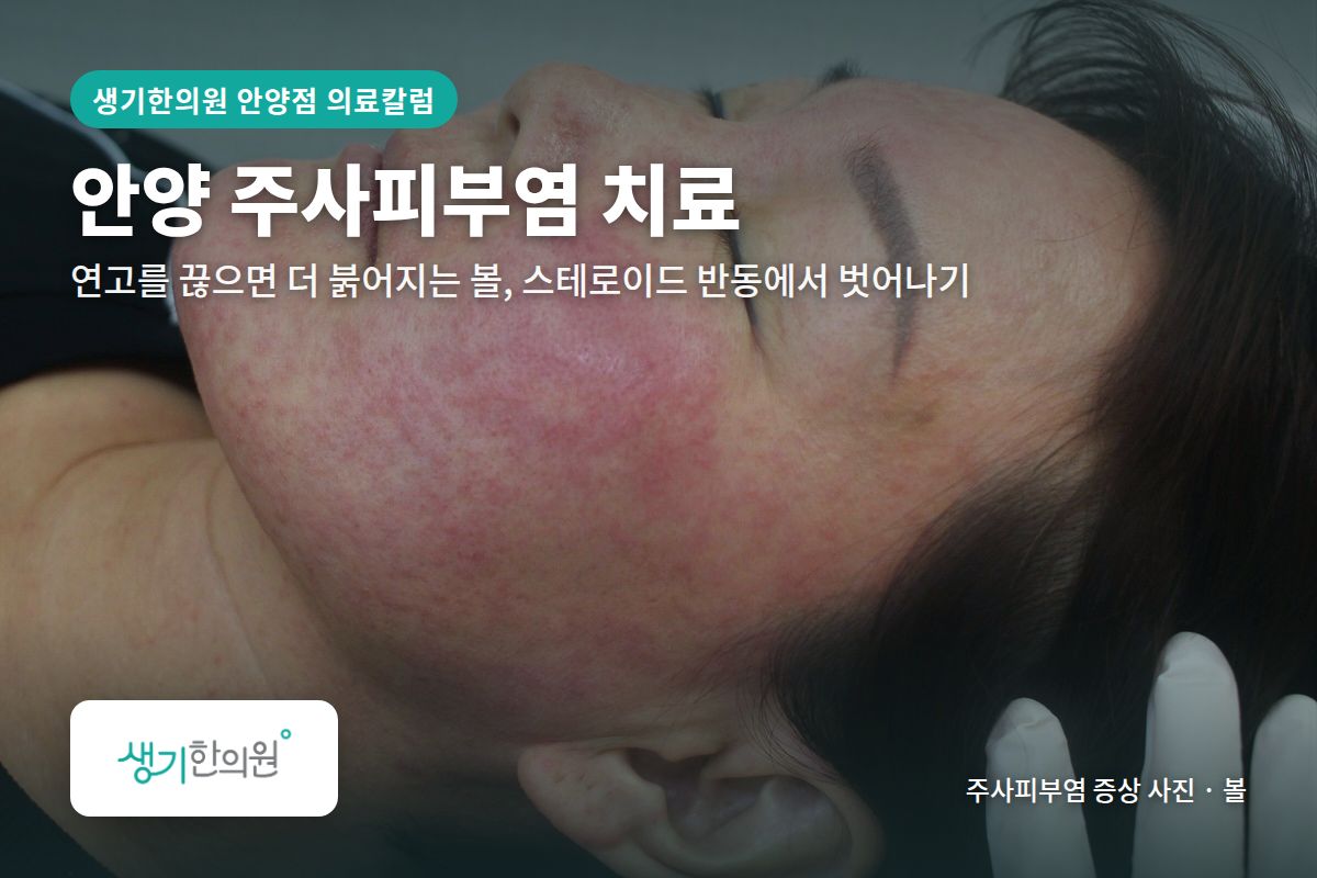 볼 주사피부염 증상 사진과 문구 「안양 주사피부염 치료, 연고를 끊으면 더 붉어지는 볼, 스테로이드 반동에서 벗어나기 · 생기한의원 안양점」