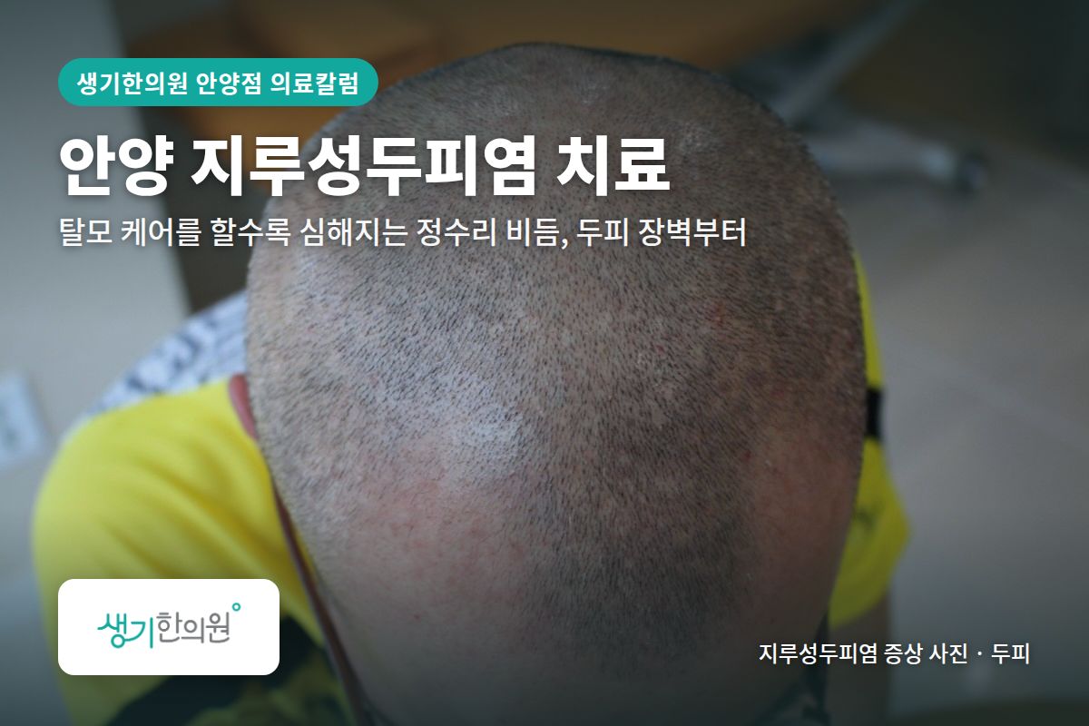 두피 지루성두피염 증상 사진과 문구 「안양 지루성두피염 치료, 탈모 케어를 할수록 심해지는 정수리 비듬, 두피 장벽부터 · 생기한의원 안양점」