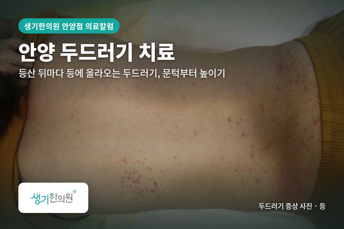 등 두드러기 증상 사진과 문구 「안양 두드러기 치료, 등산 뒤마다 등에 올라오는 두드러기, 문턱부터 높이기 · 생기한의원 안양점」